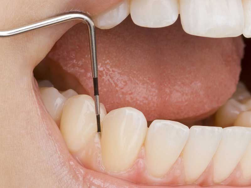 Zahnarzt [  Parodontitis Soest ] - Praxis Dr. Elke Hubiak