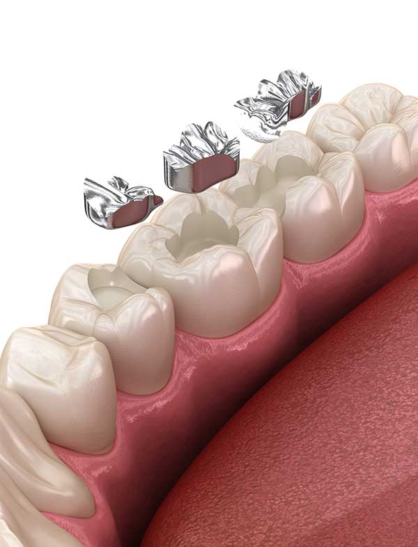 Zahnarzt [  Füllungstherapie Amalgamsanierung Soest ] - Praxis Dr. Elke Hubiak