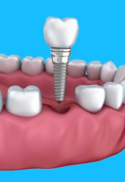 Zahnarzt [  Implantate Soest ] - Praxis Dr. Elke Hubiak