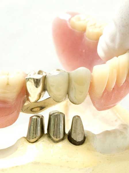 Zahnarzt [  Geschiebeprothese Ohne Klammern Soest ] - Praxis Dr. Elke Hubiak